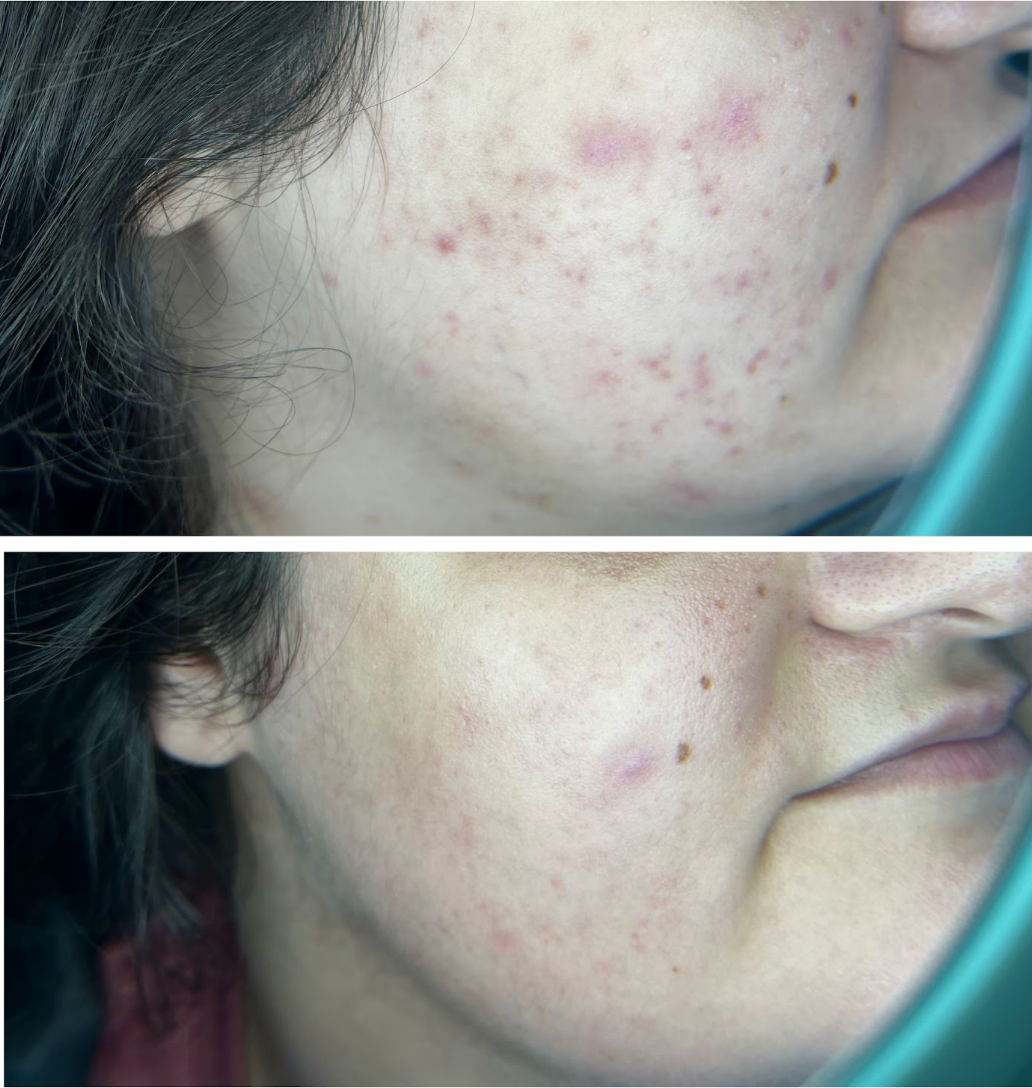 Antes e depois de Tratamento para Acne