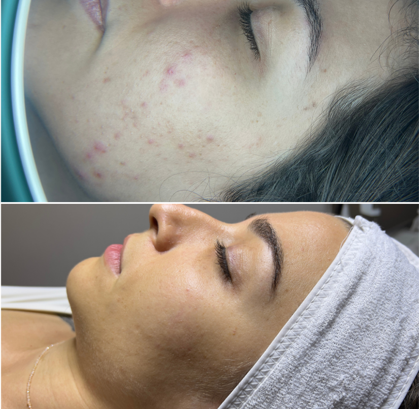 Antes e depois de Tratamento para Acne