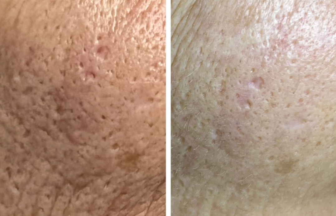 Antes e depois de tratamento para Cicatrizes de Acne