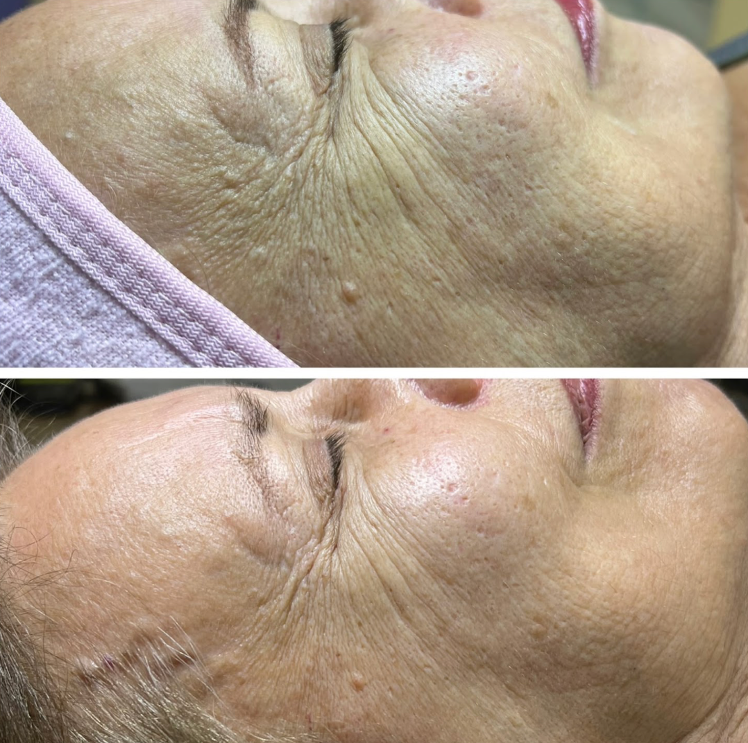 Antes e depois de tratamento para Cicatrizes de Acne