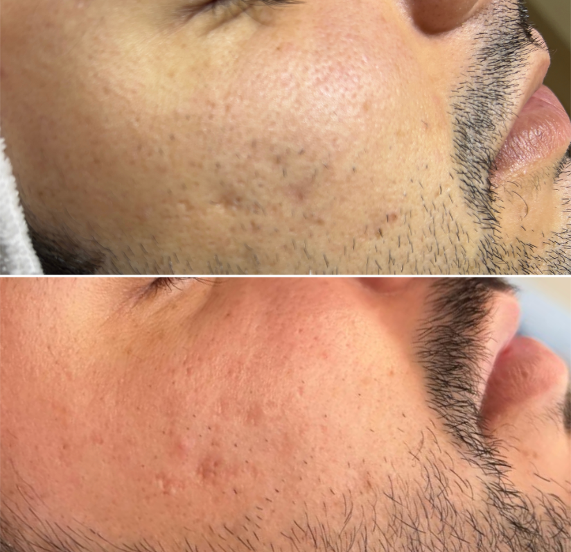 Antes e depois de tratamento para Cicatrizes de Acne