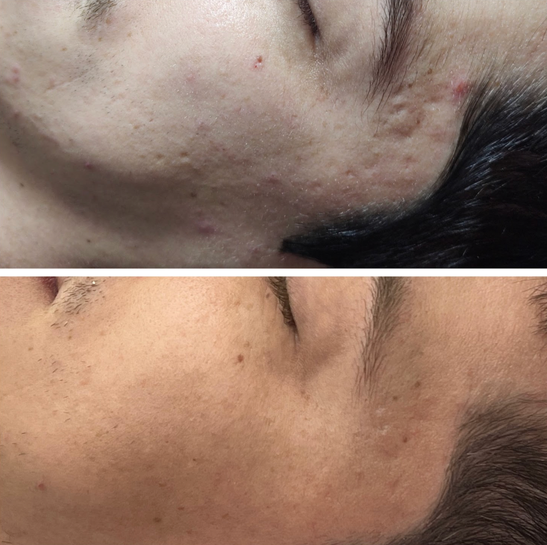 Antes e depois de tratamento para Cicatrizes de Acne