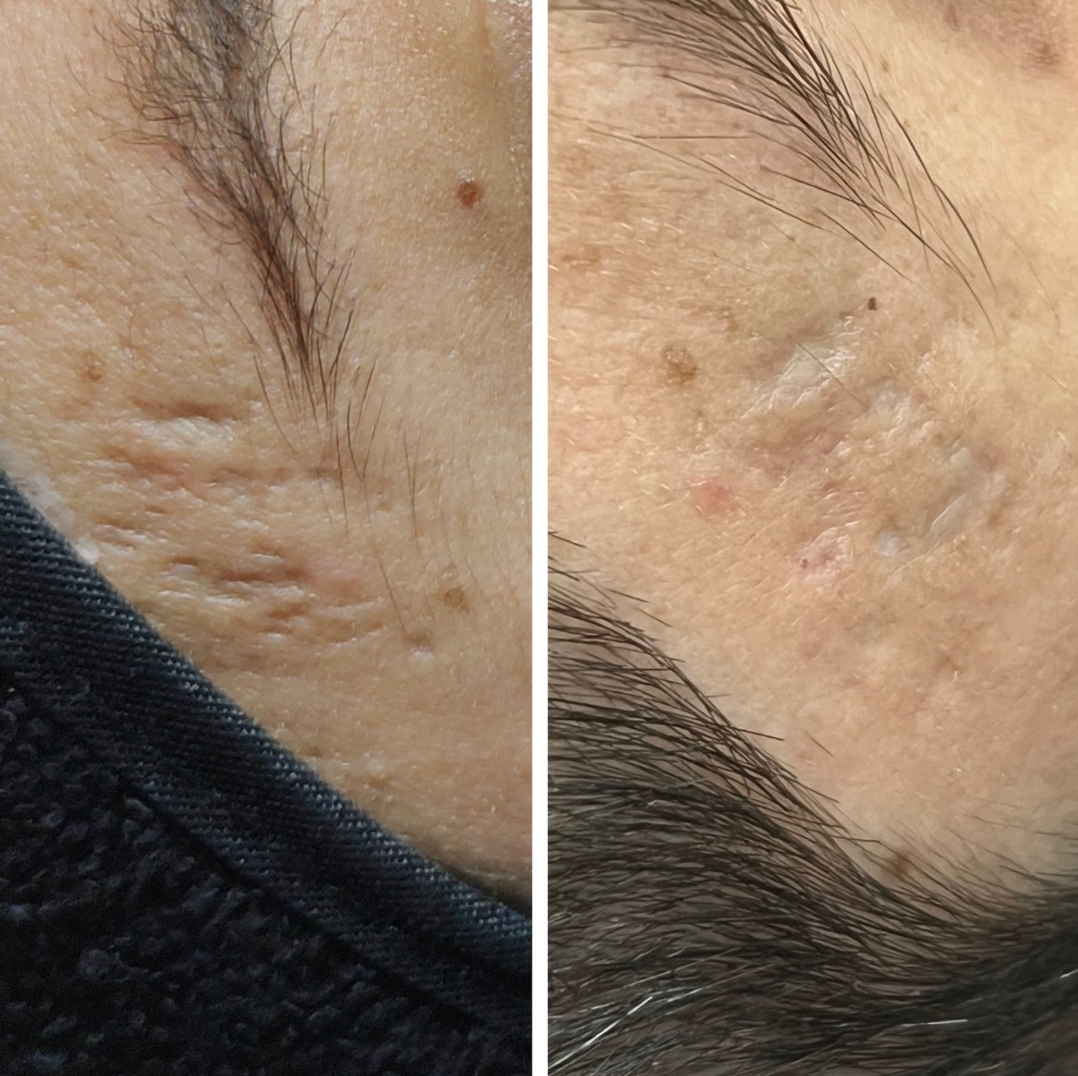 Antes e depois de tratamento para Cicatrizes de Acne