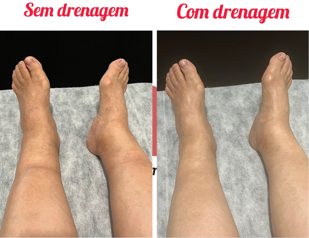 Antes e depois de Drenagem Linfática Orgânica