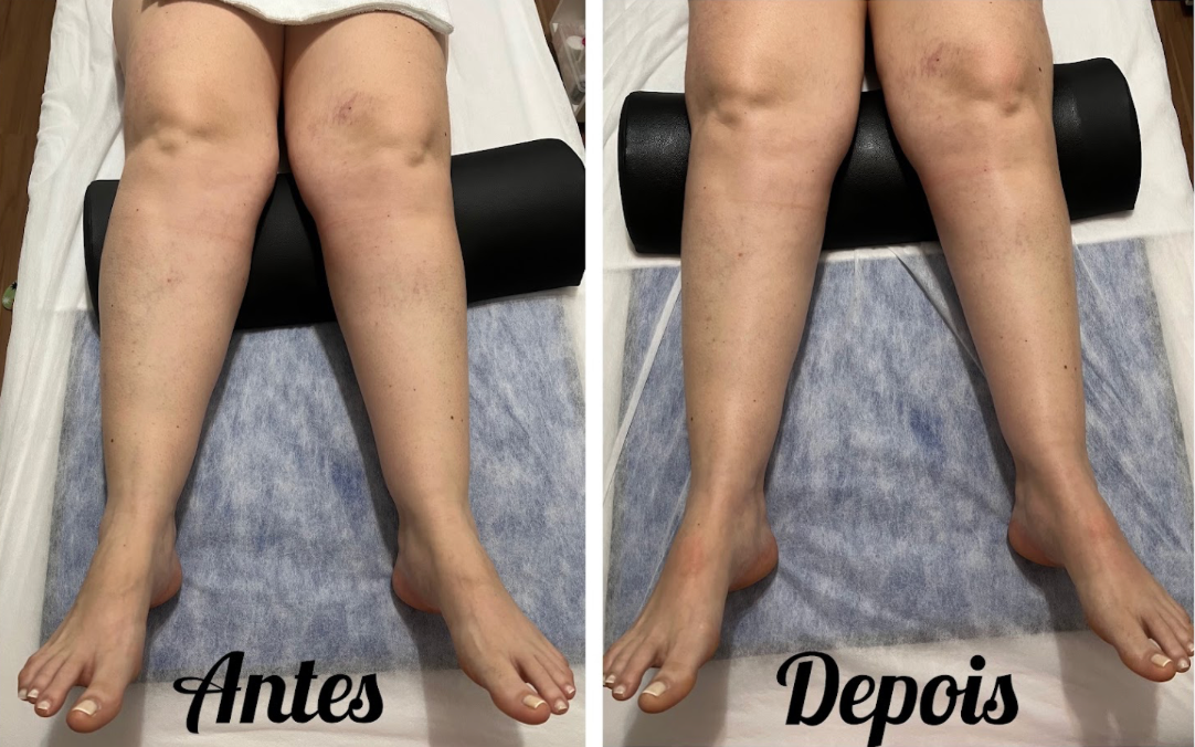 Antes e depois de Drenagem Linfática Orgânica