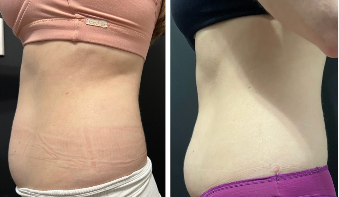 Antes e depois de tratamento para Gordura Localizada