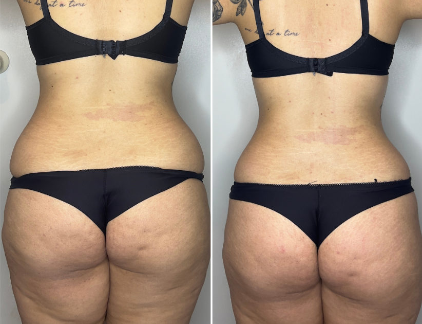 Antes e depois de tratamento para Gordura Localizada
