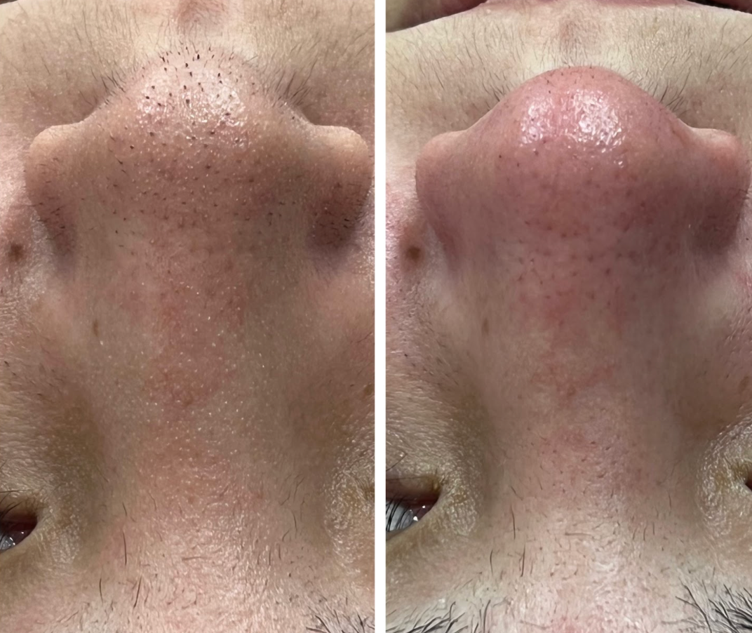 Antes e depois de Limpeza de Pele Avançada