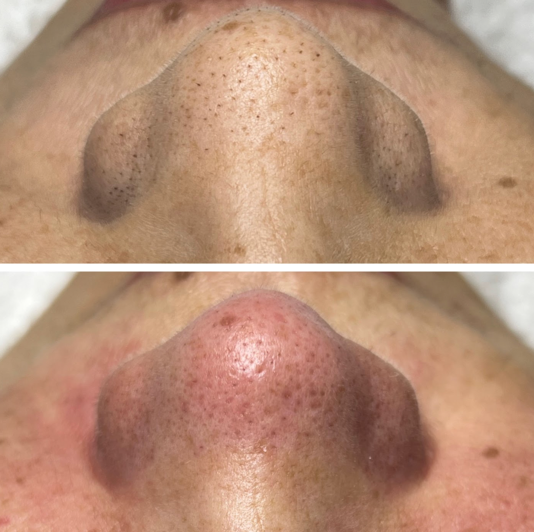 Antes e depois de Limpeza de Pele Avançada