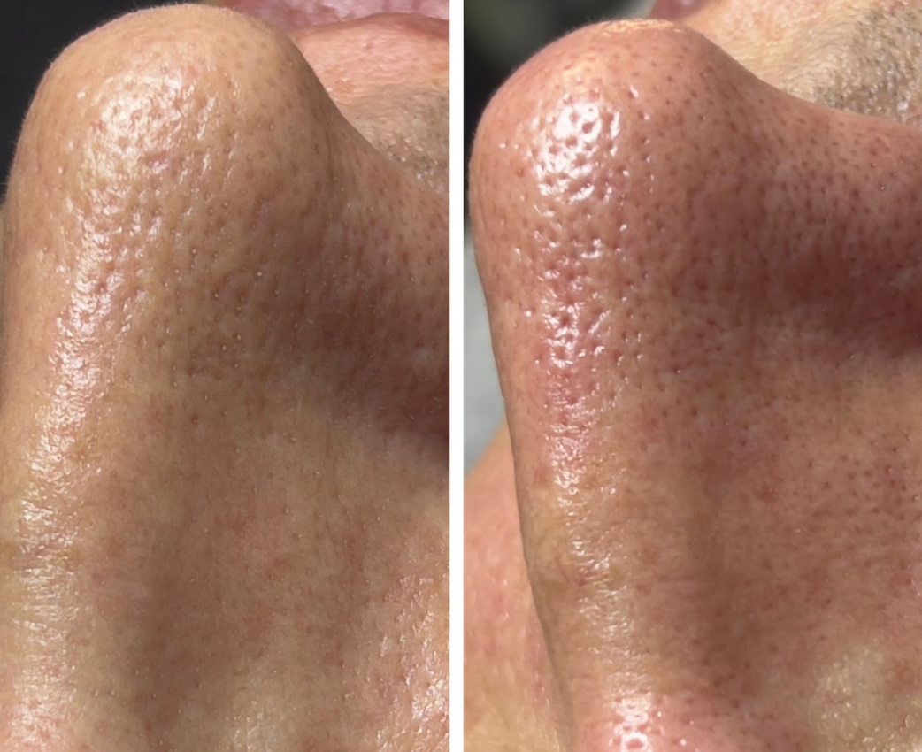 Antes e depois de Limpeza de Pele Avançada