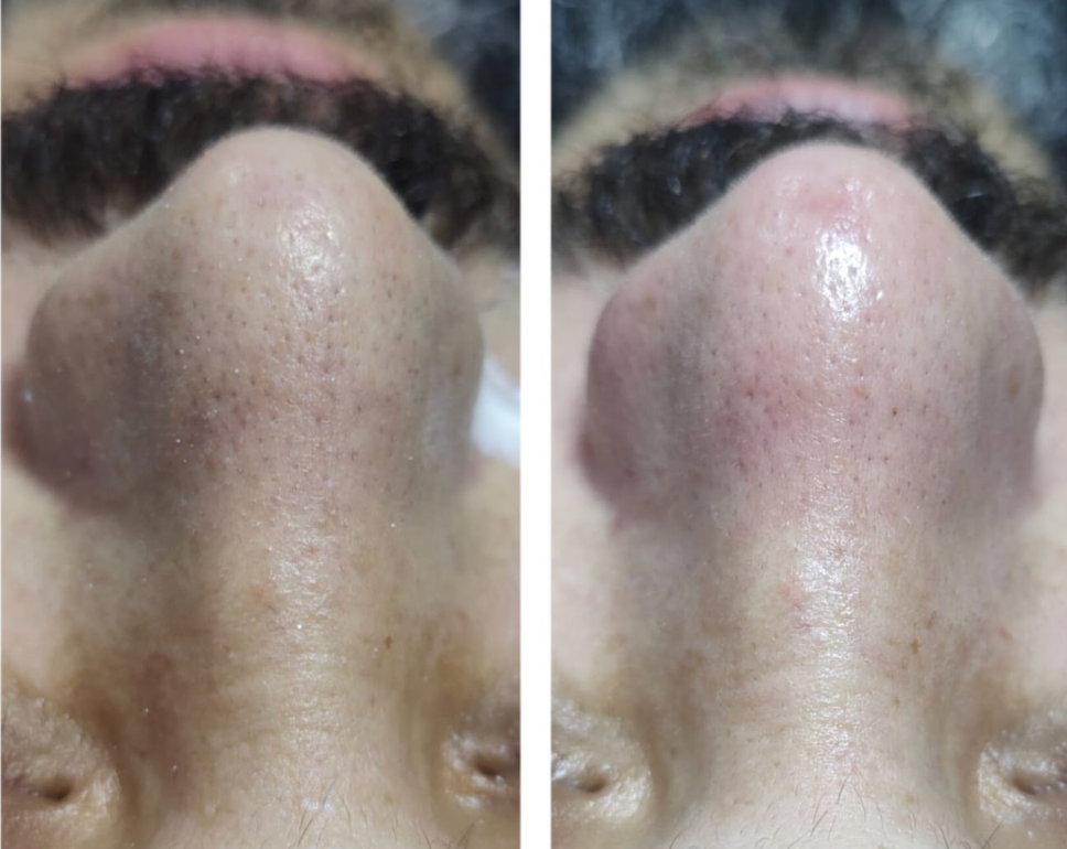 Antes e depois de Limpeza de Pele Avançada