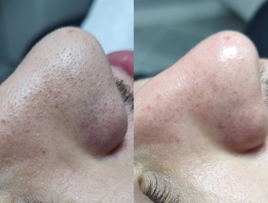Antes e depois de Limpeza de Pele Avançada
