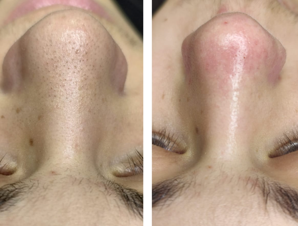 Antes e depois de Limpeza de Pele Avançada