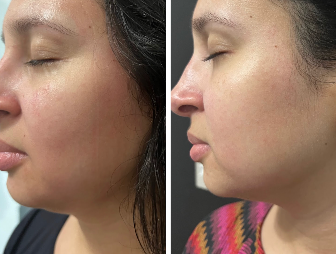 Antes e depois de Rejuvenescimento Facial