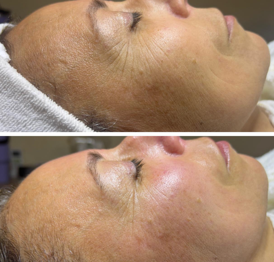 Antes e depois de Rejuvenescimento Facial