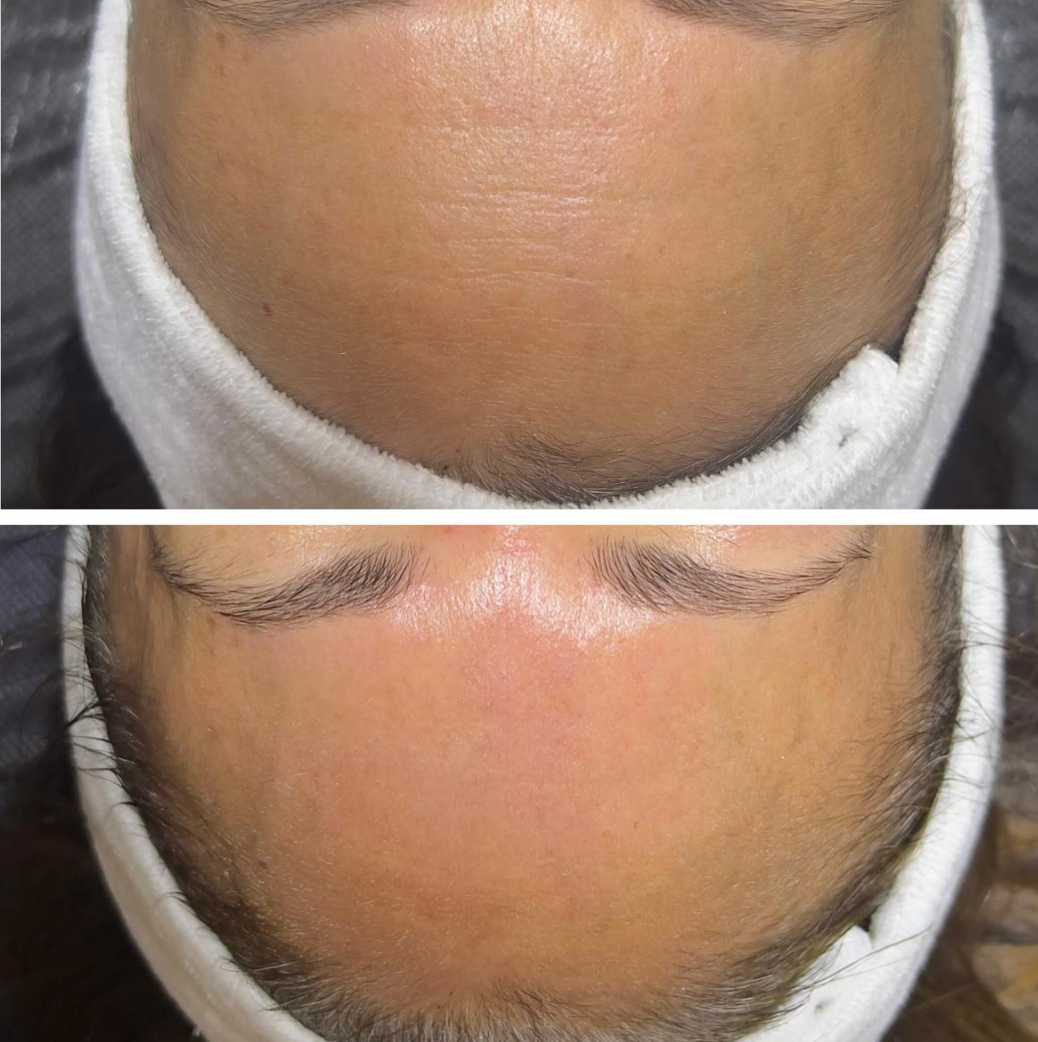 Antes e depois de Rejuvenescimento Facial