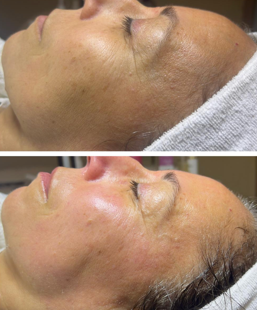 Antes e depois de Rejuvenescimento Facial